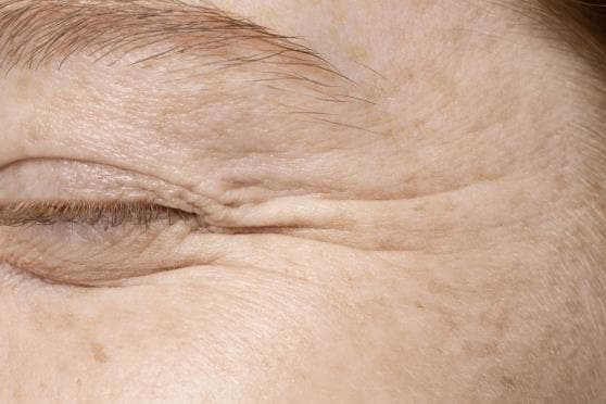 Fine Lines & Wrinkles