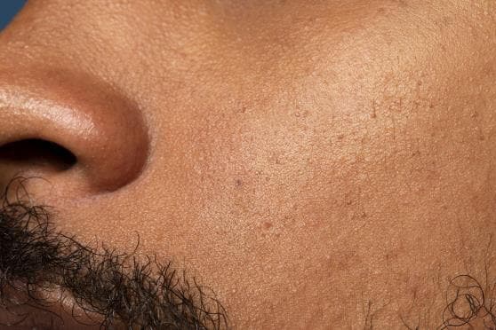 Skin Texture