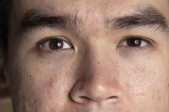 Enlarged Pores